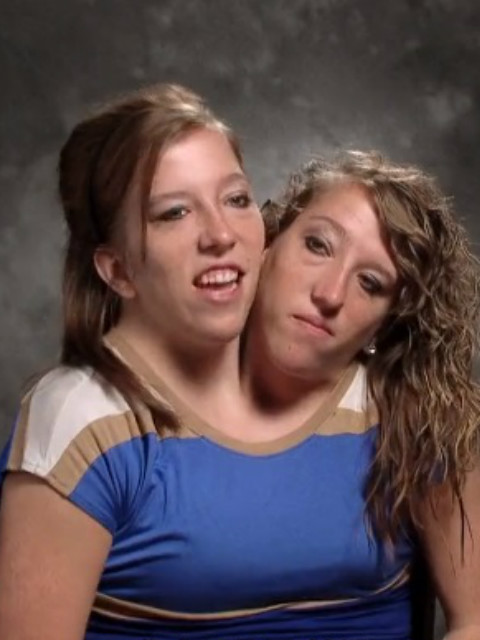 连体姐妹花：艾比和布列塔尼封面图